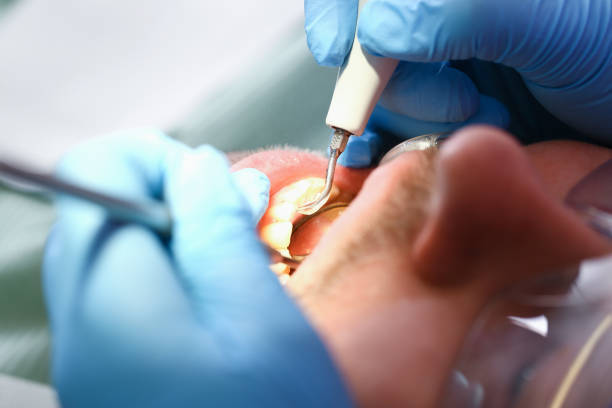 Best Emergency Dentist for Lost Fillings or Crowns in Oakland City, IN